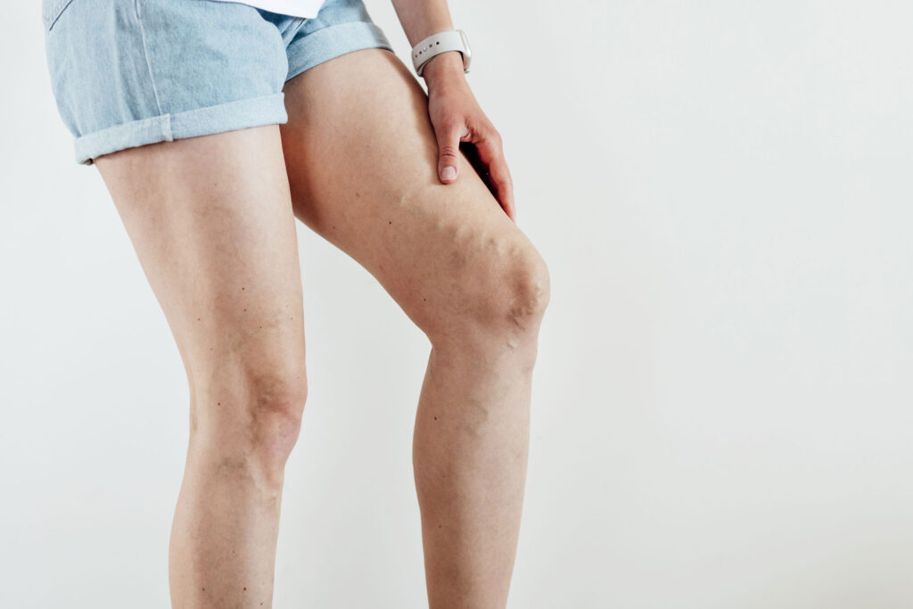 Spider Veins Vein Treatment Clinic of Tulsa